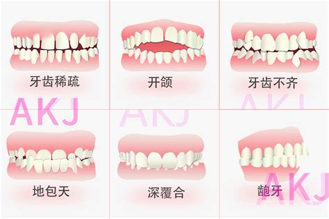 上下排牙齒平行|上下排牙齒貼到實 竟然不是正常的咬合？(上) 